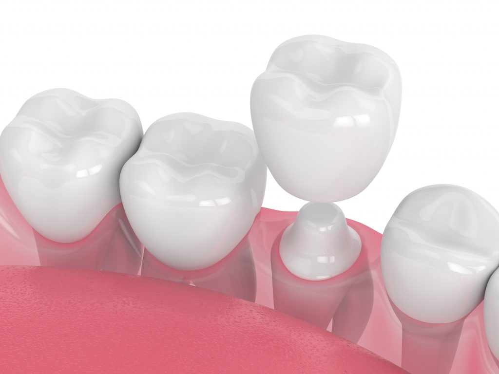The Process of Obtaining a Dental Crown