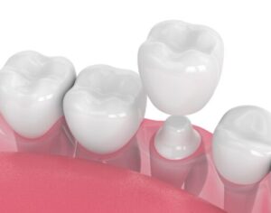 The Process of Obtaining a Dental Crown