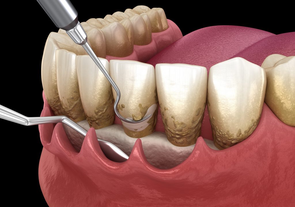 Concerning Facts about Periodontal Disease