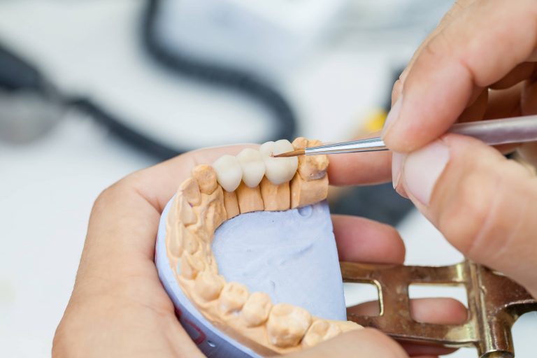 What’s The Difference between Dental Bridges and Dental Implants?