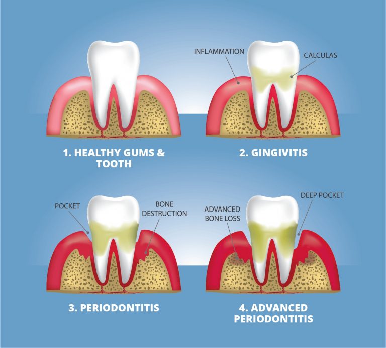 progressions stages of gum disease periodontitis