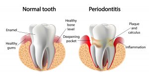 normal tooth and periodontitis tooth
